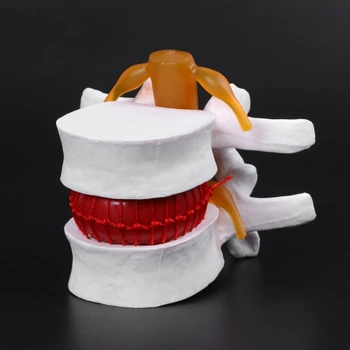 Človekove Anatomski Ledvenega Diska Herniation Model Medicinske Naučijo Pomoči, Anatomijo Instrume